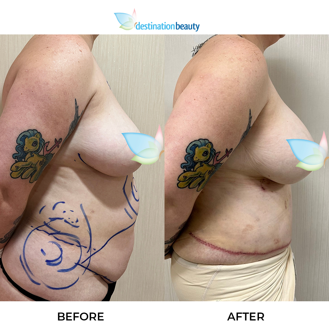 Breast Augmentation, Extended Tummy Tuck, and Liposuction (3)