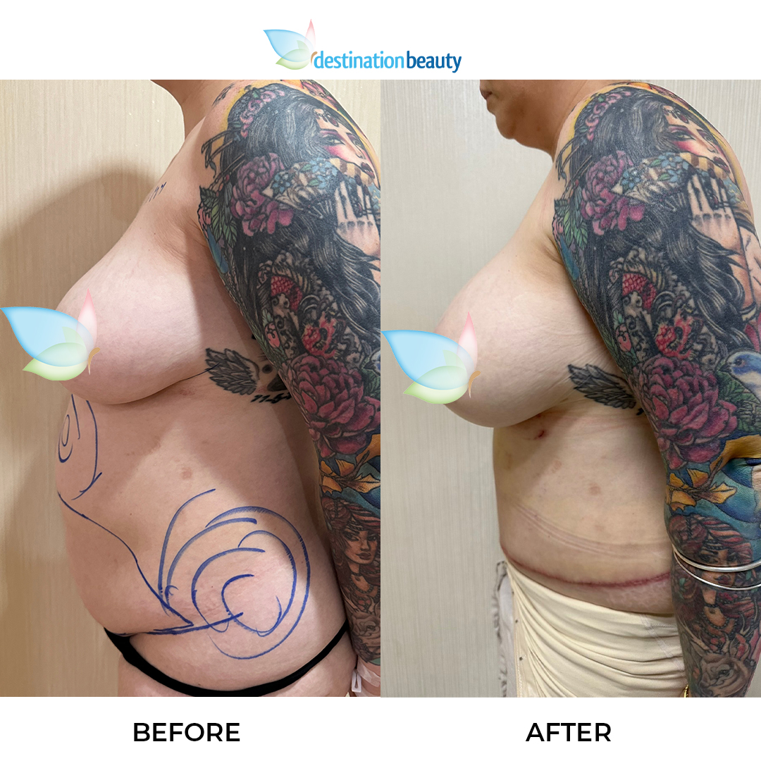 Breast Augmentation, Extended Tummy Tuck, and Liposuction