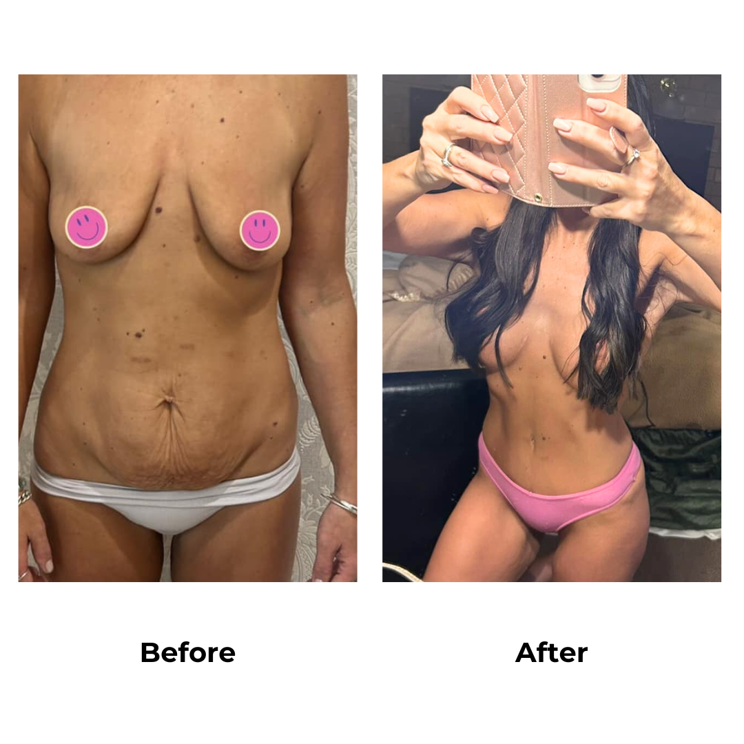 Breast augmentation with lift and tummy tuck with Dr. Ring