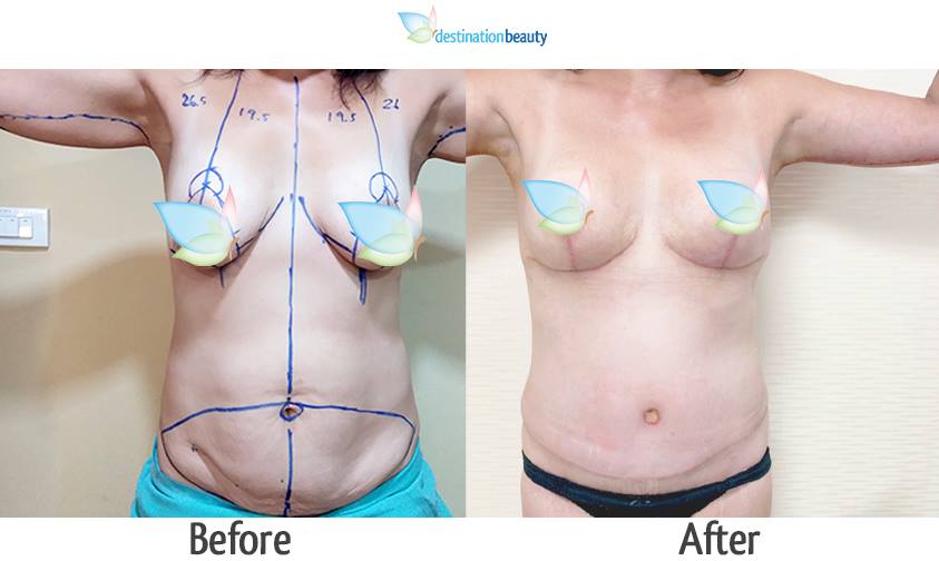 Breast reduction, arm lift, and extended tummy tuck in Thailand