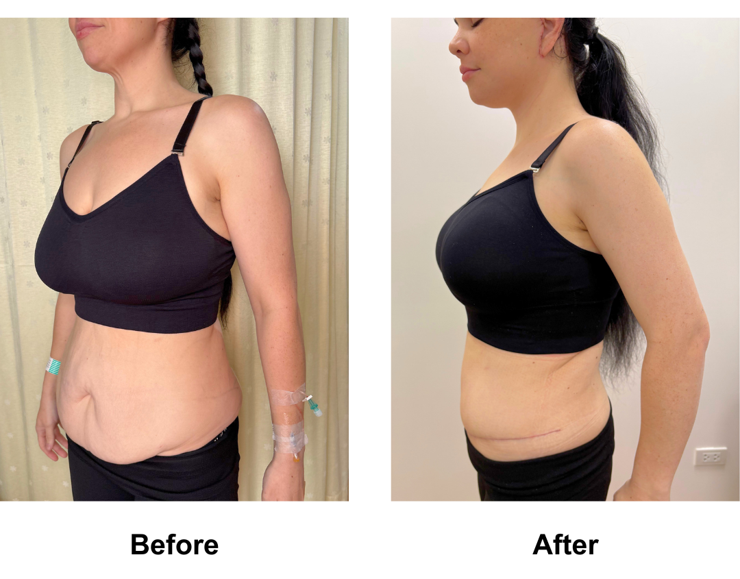 Brigid had Semi-circim TT + Lipo 2 + Mons lift with Dr. Ring  (2)