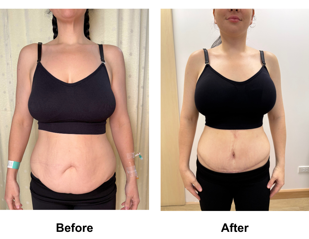 Brigid had Semi-circim TT + Lipo 2 + Mons lift with Dr. Ring  (3)