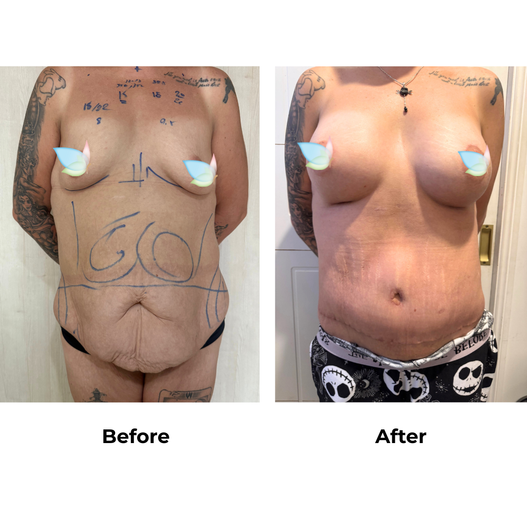 Brooke had BA, Nipple Lift + Arm Lift + Lipo arms, upper ab, love handles,  ExTT + Mons Lift Dr. Kasemsak - 4 weeks
