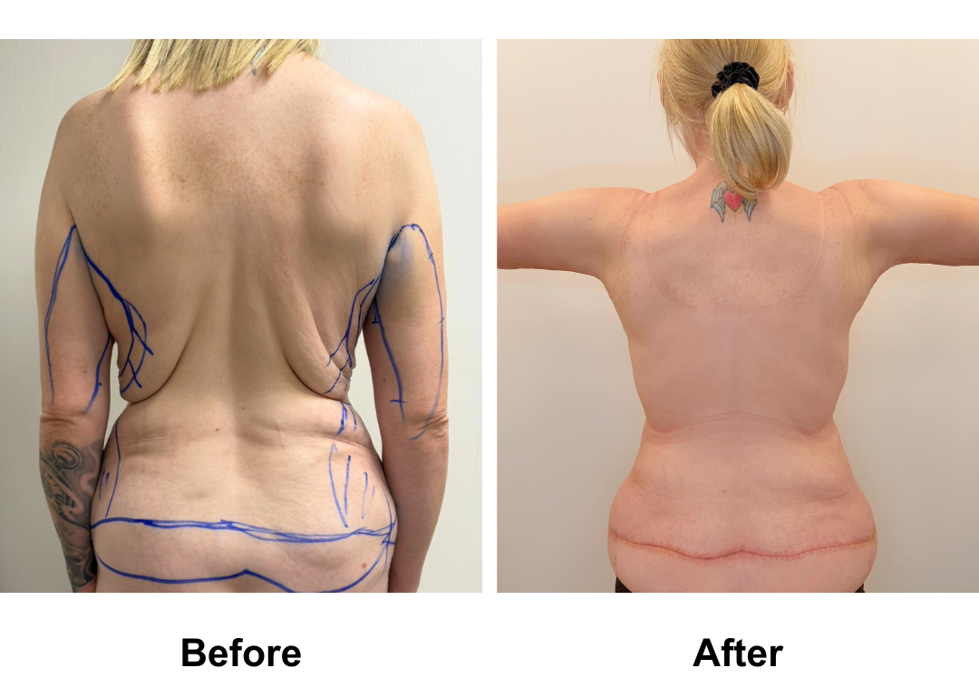 Brooke had Circum TT + VASER lipo 2 areas on upper abs & love handles + Mons lift + BABL (335, 355 Full) + Back Lift (side incision) + AL with Dr. Ring (1)