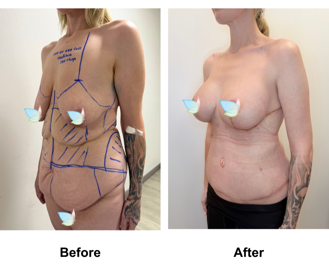 Brooke had Circum TT + VASER lipo 2 areas on upper abs & love handles + Mons lift + BABL (335, 355 Full) + Back Lift (side incision) + AL with Dr. Ring (2)