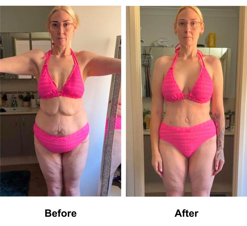 Brooke had Circum TT + VASER lipo 2 areas on upper abs & love handles + Mons lift + BABL (335, 355 Full) + Back Lift (side incision) + AL with Dr. Ring (3)