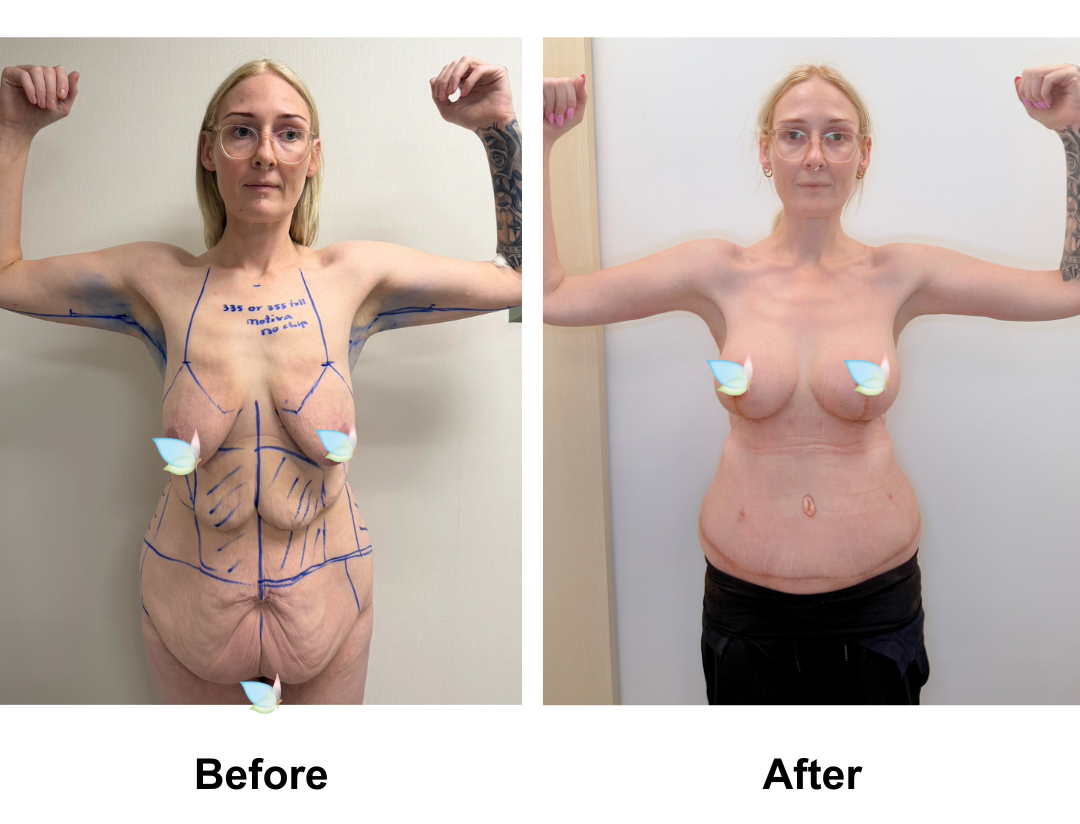 Brooke had Circum TT + VASER lipo 2 areas on upper abs & love handles + Mons lift + BABL (335, 355 Full) + Back Lift (side incision) + AL with Dr. Ring