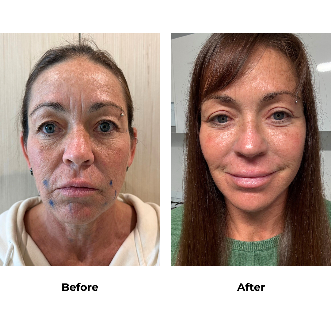 Brooke had MFNL + Upper Eyelid + Fat transfer to face with Dr. NJ (2)