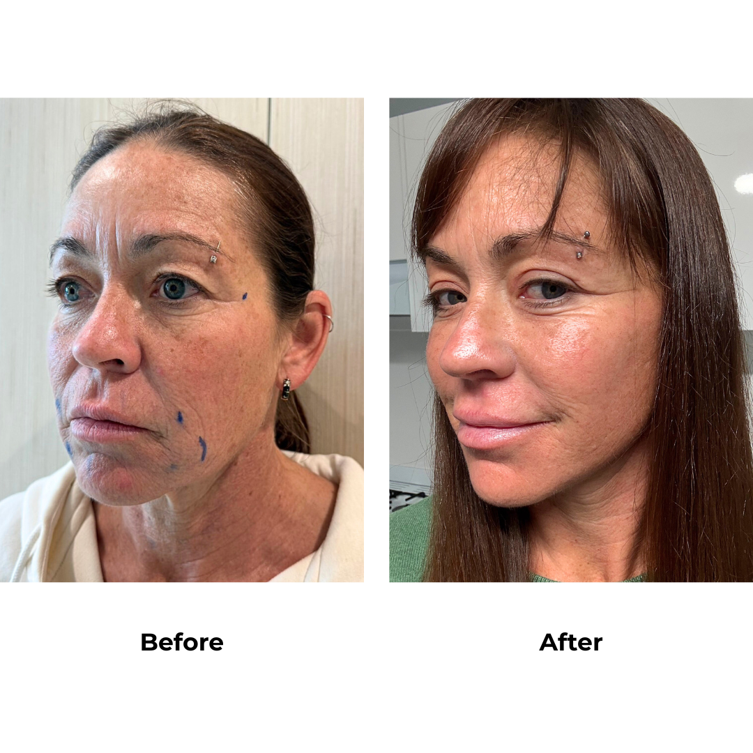 Brooke had MFNL + Upper Eyelid + Fat transfer to face with Dr. NJ