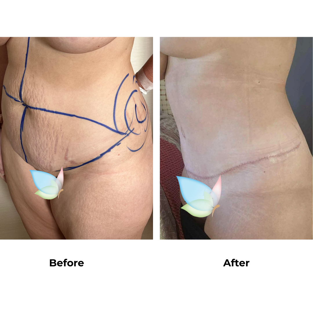 Carla had ExTT + VASER on love handles + Mons lift with Dr. Angkana (2)