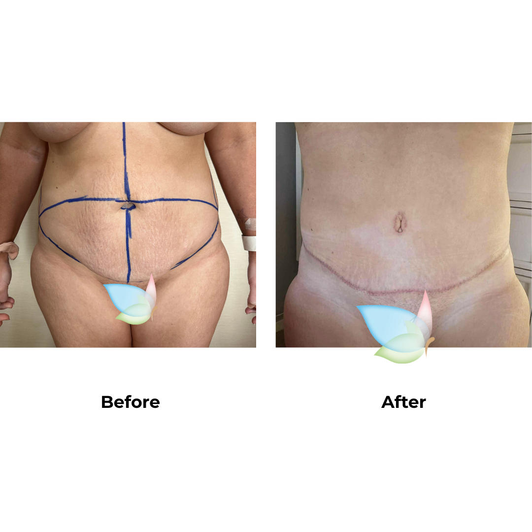 Carla had ExTT + VASER on love handles + Mons lift with Dr. Angkana
