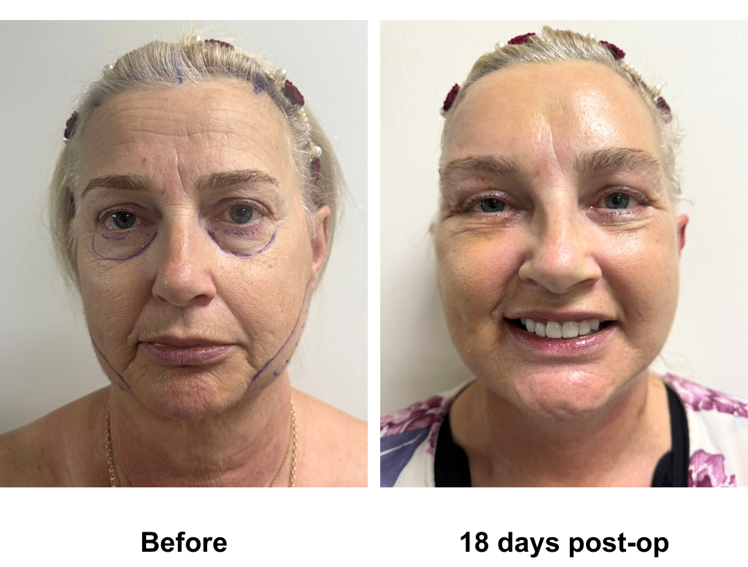 Carol had MFNL + EBL + LB + Lipo along the Jowls + 16 veneers with Dr. Ring