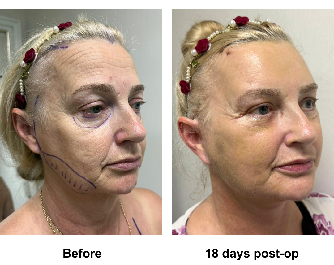 Carol had MFNL + EBL + LB + Lipo along the Jowls with Dr. Ring
