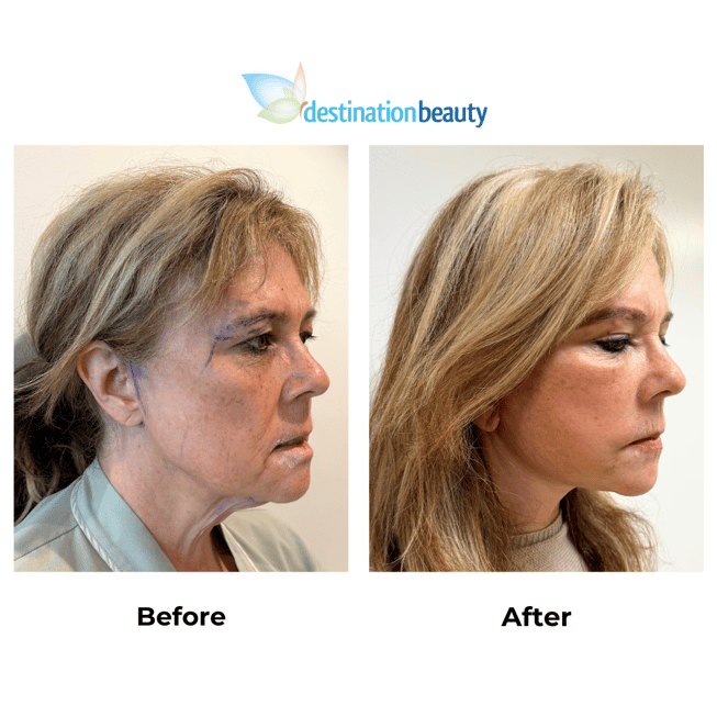 Carol had Midface and neck lift revision with Dr. Ring - 2 weeks post-op 2