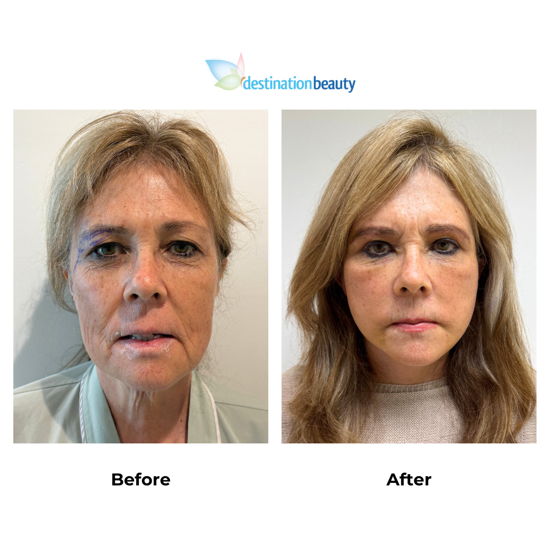 Carol had Midface and neck lift revision with Dr. Ring - 2 weeks post-op