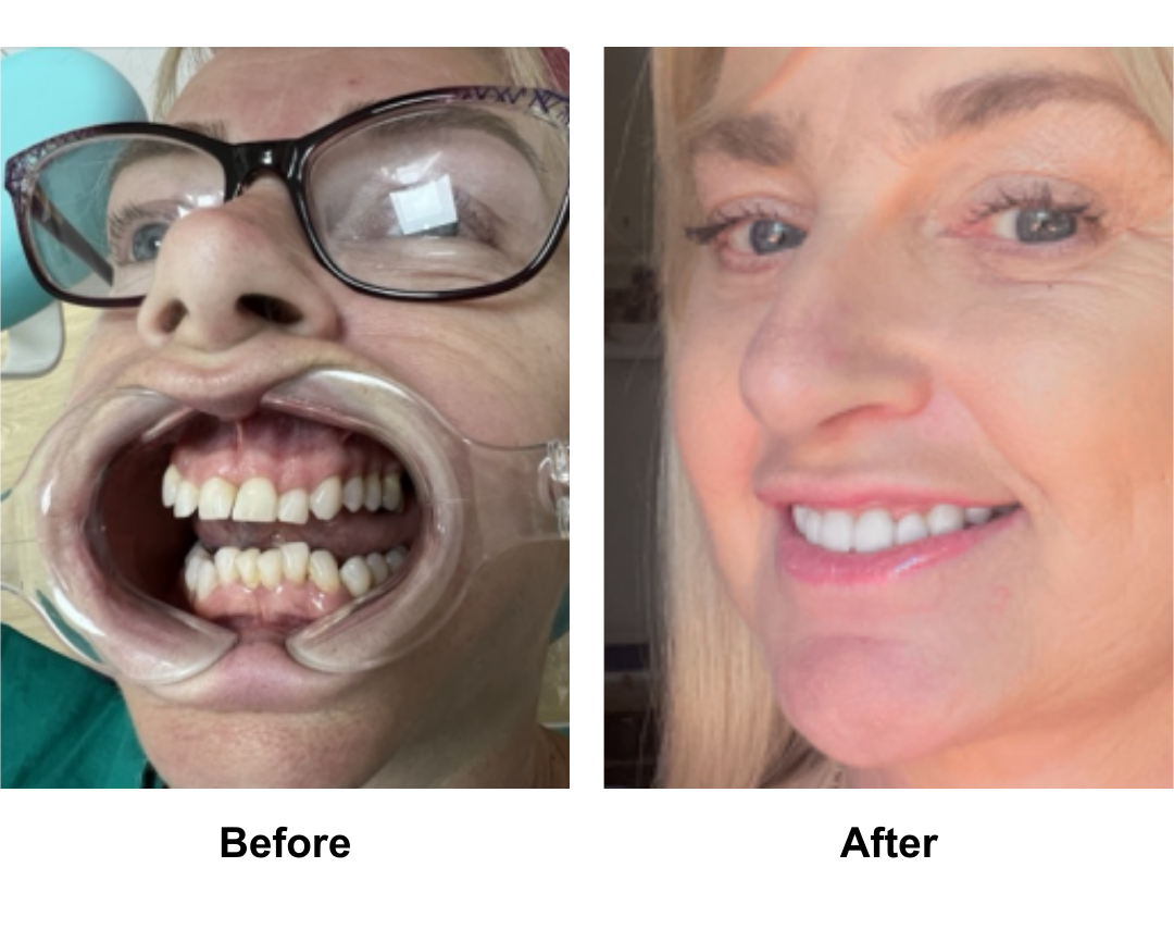 Carol, 59 had MFNL + EBL + LB + Lipo along the Jaw with Dr. Ring + 16 veneers (1)-1