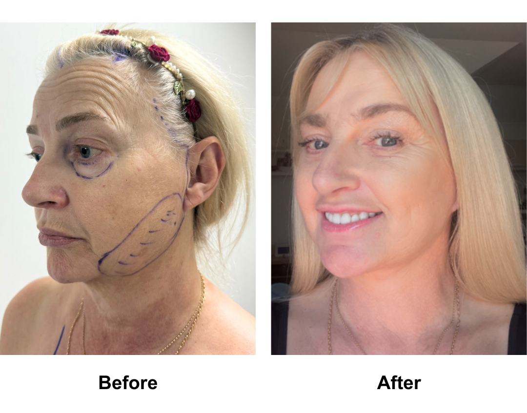 Carol, 59 had MFNL + EBL + LB + Lipo along the Jaw with Dr. Ring + 16 veneers (1)