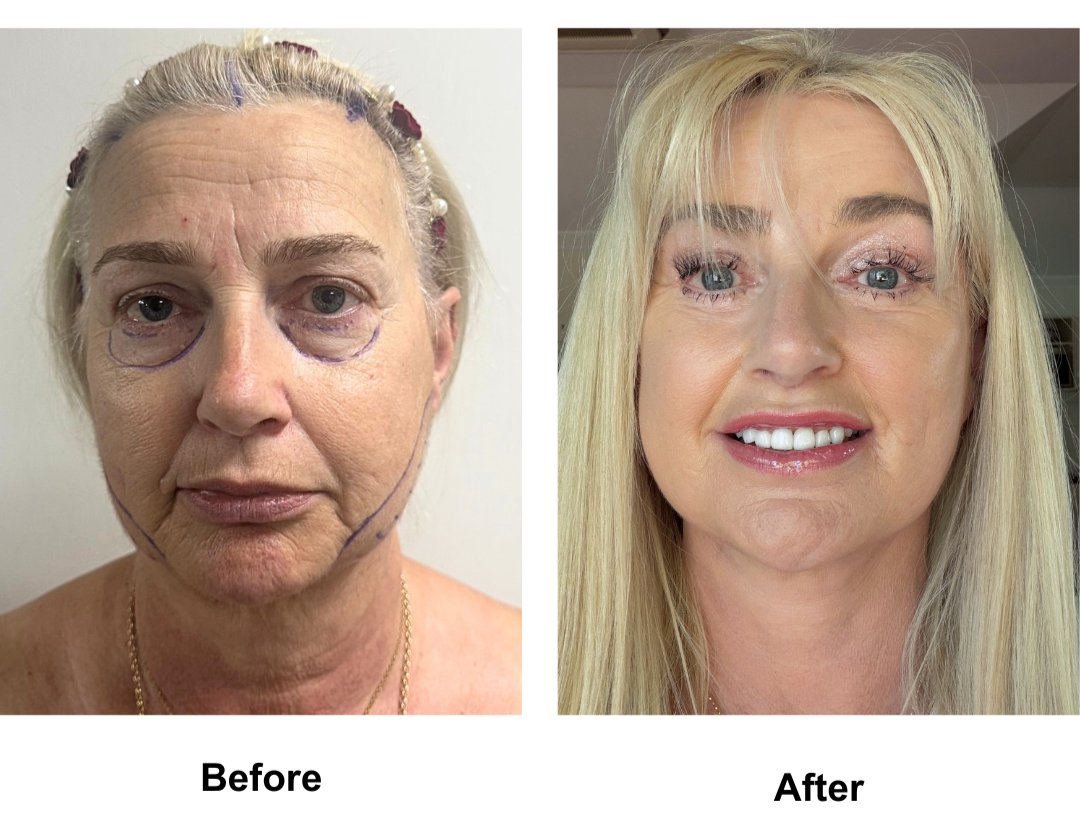 Carol, 59 had MFNL + EBL + LB + Lipo along the Jaw with Dr. Ring + 16 veneers (10)