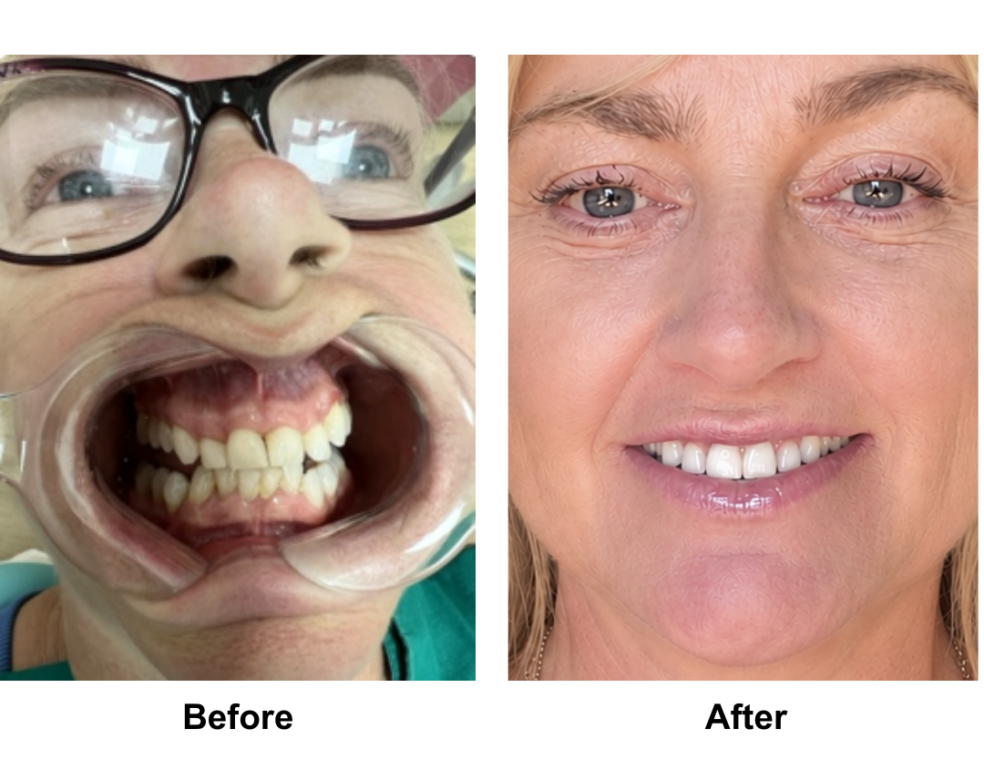 Carol, 59 had MFNL + EBL + LB + Lipo along the Jaw with Dr. Ring + 16 veneers (2)-1