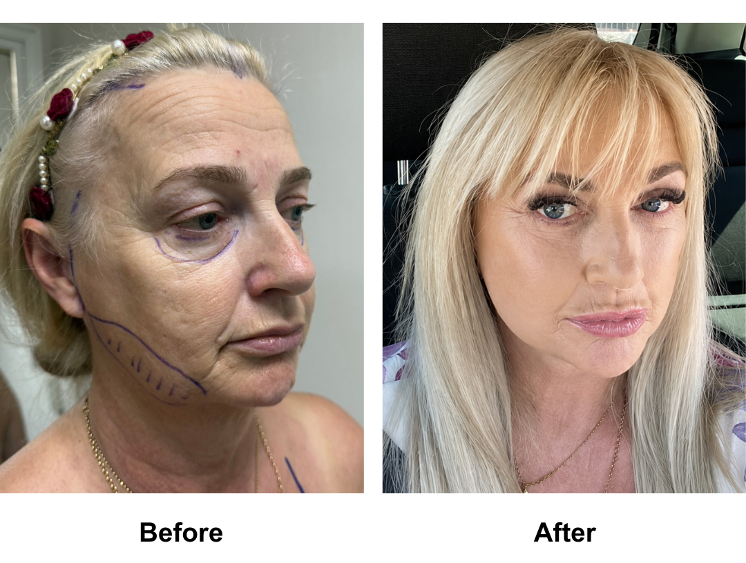 Carol, 59 had MFNL + EBL + LB + Lipo along the Jaw with Dr. Ring + 16 veneers (2)