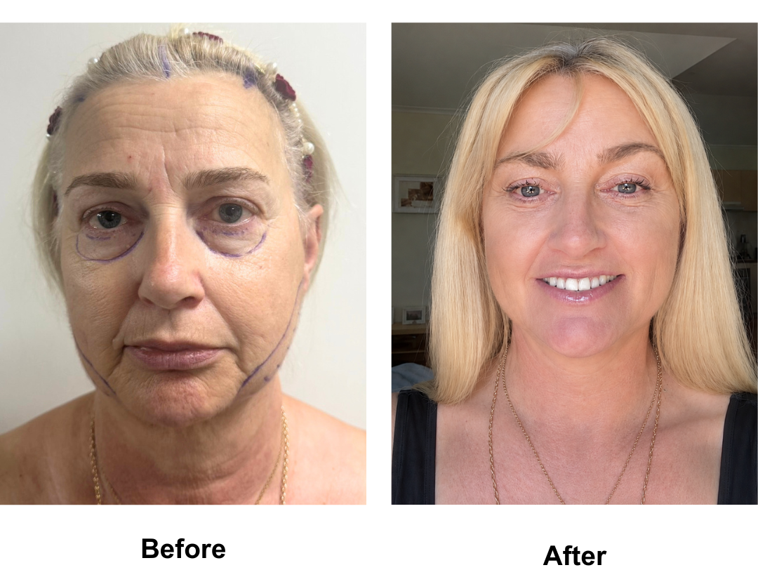 Carol, 59 had MFNL + EBL + LB + Lipo along the Jaw with Dr. Ring + 16 veneers (3)