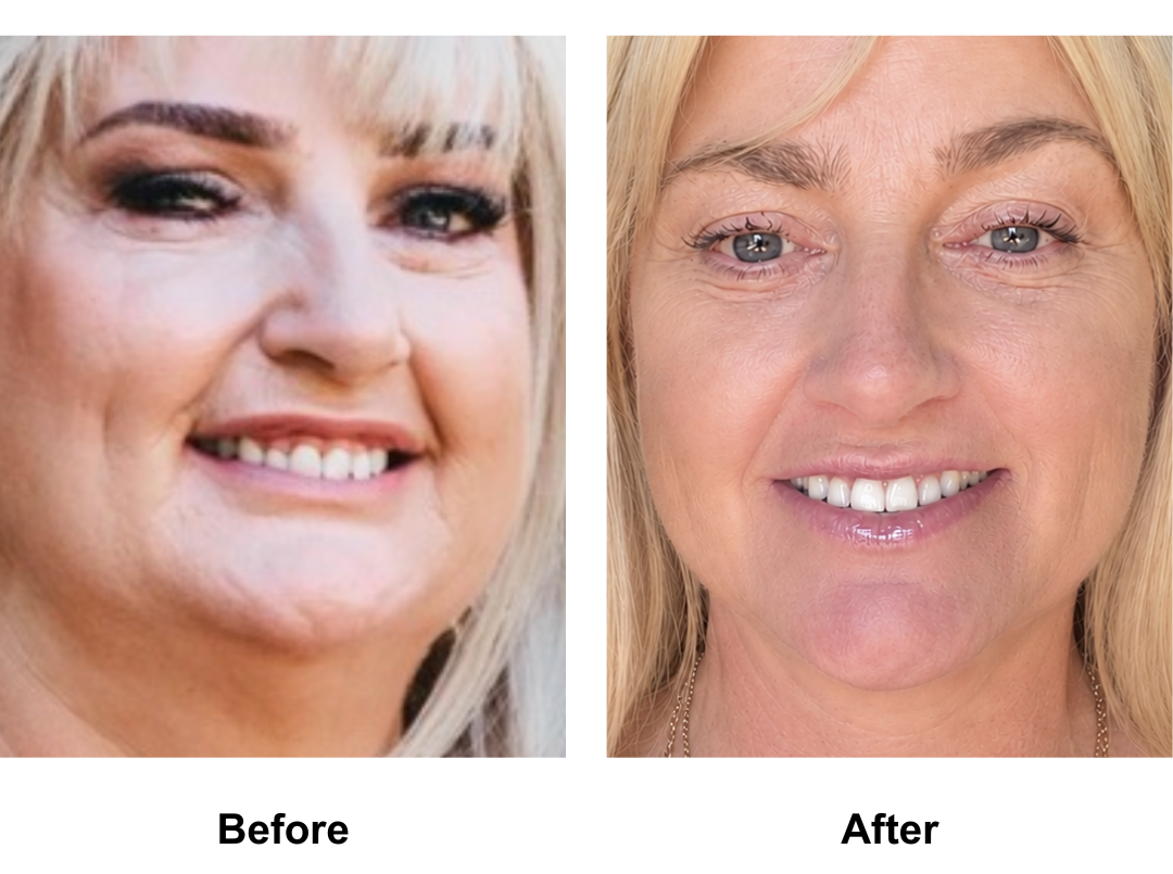 Carol, 59 had MFNL + EBL + LB + Lipo along the Jaw with Dr. Ring + 16 veneers (8)