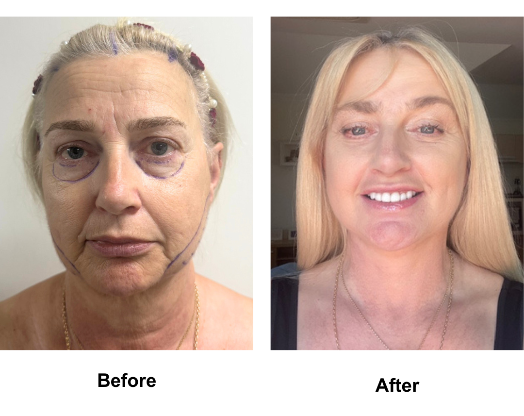 Carol, 59 had MFNL + EBL + LB + Lipo along the Jaw with Dr. Ring + 16 veneers