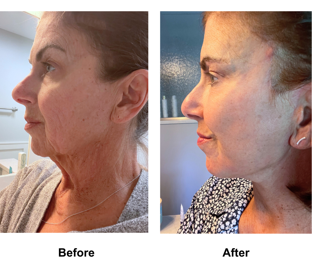 Carol, 69 had FFNL + Plastysmaplasty + sub brow lift + fat transfer to face with Dr. NJ (3)