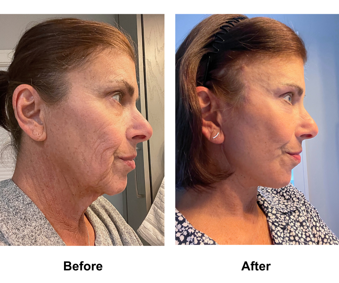 Carol, 69 had FFNL + Plastysmaplasty + sub brow lift + fat transfer to face with Dr. NJ (4)