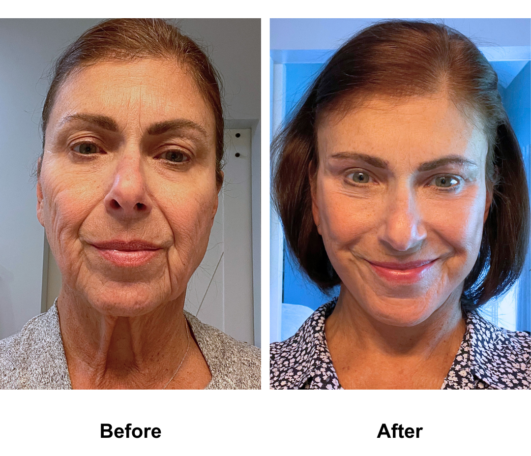 Carol, 69 had FFNL + Plastysmaplasty + sub brow lift + fat transfer to face with Dr. NJ