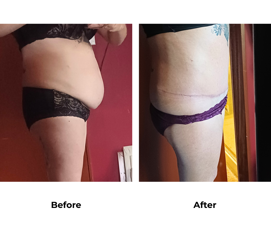 Caroline had ExTT + lipo upper abs with Dr. Ring  (1)