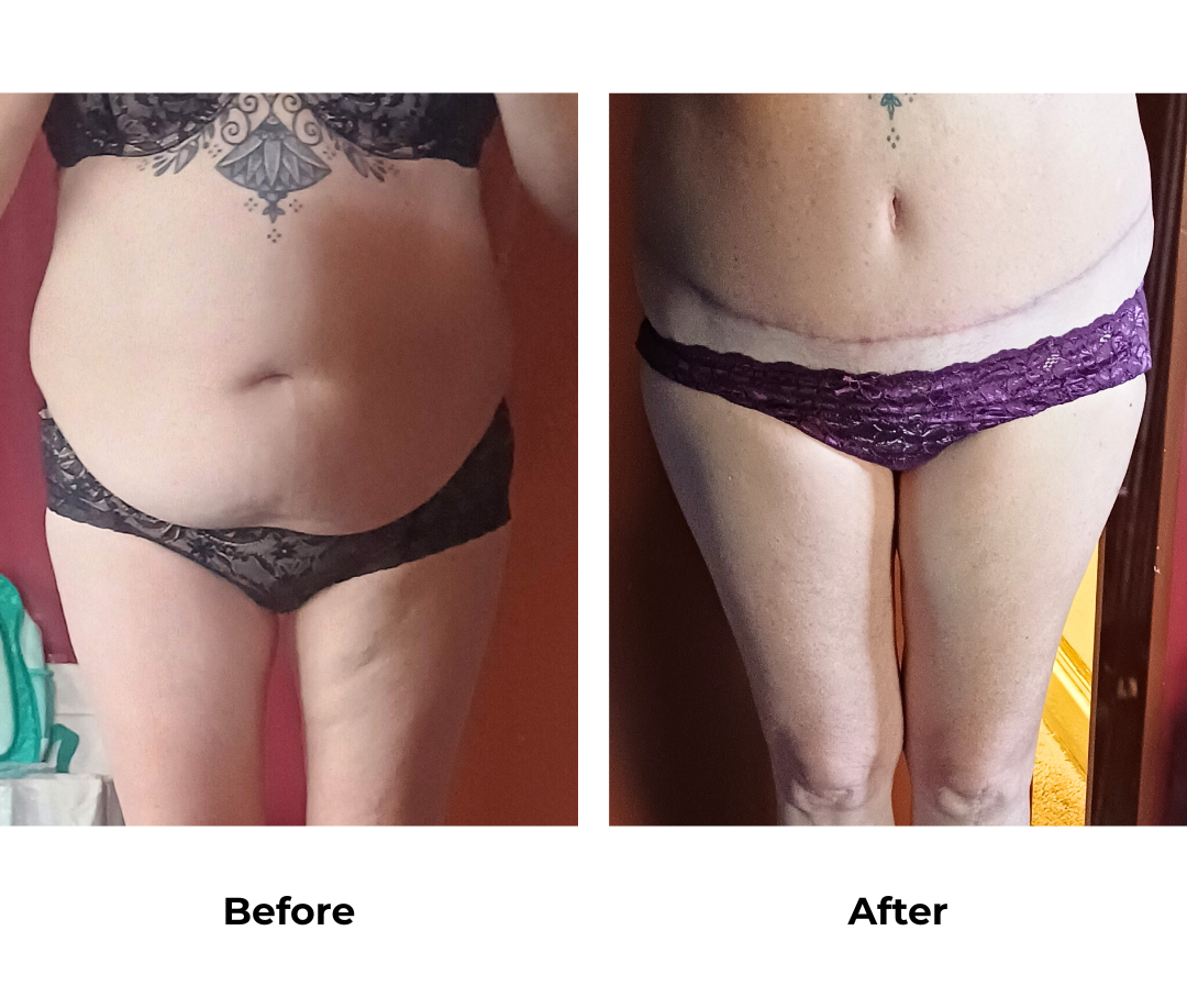Caroline had ExTT + lipo upper abs with Dr. Ring