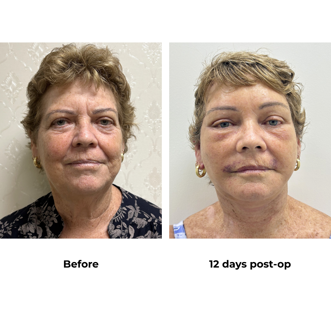 Carolyn had FFNL + Endo Brow Lift with Dr. Ring (2)