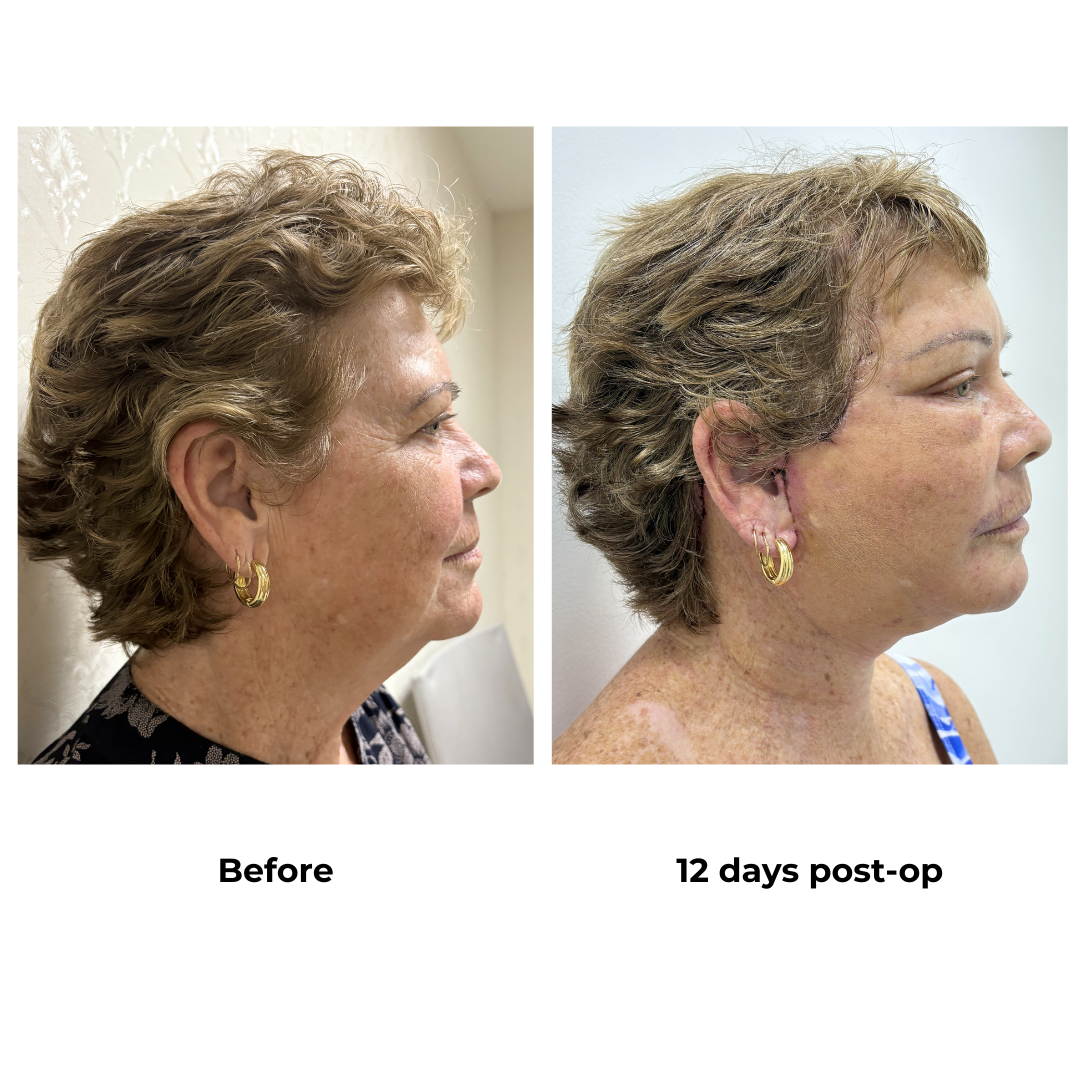 Carolyn had FFNL + Endo Brow Lift with Dr. Ring