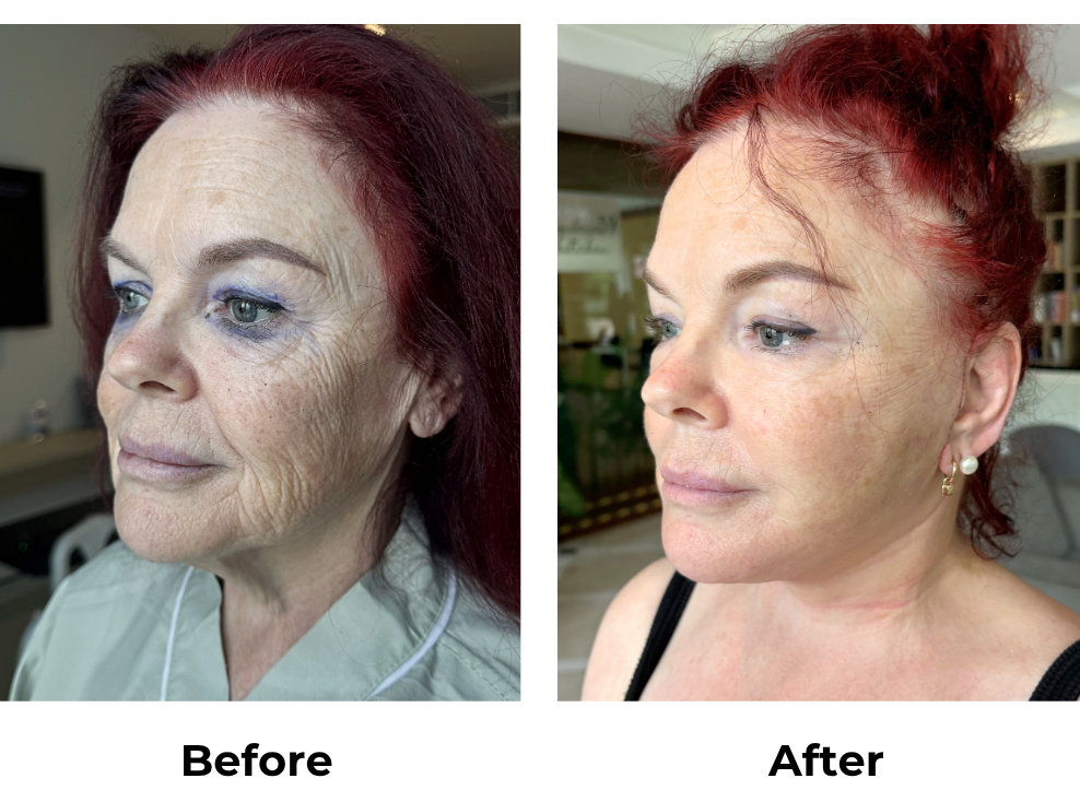 Carolyn had MFNL + Platysmaplasty with Dr. Jatuporn (2)