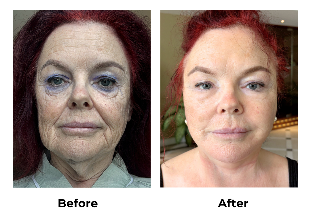 Carolyn had MFNL + Platysmaplasty with Dr. Jatuporn 1