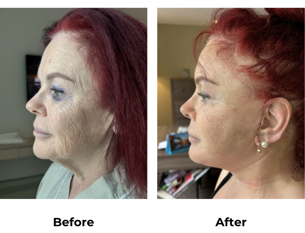Carolyn had MFNL + Platysmaplasty with Dr. Jatuporn-1
