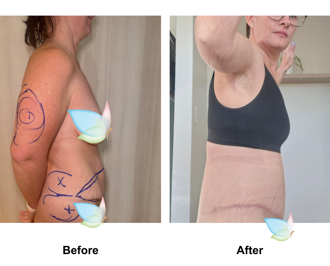 Carrie had ExTT + Lipo x2 + AL + Mons lift with Dr. Weerachai (1)