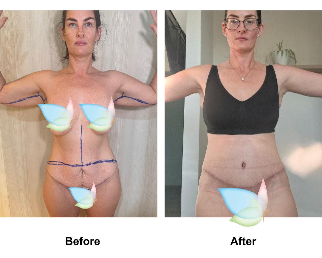 Carrie had ExTT + Lipo x2 + AL + Mons lift with Dr. Weerachai