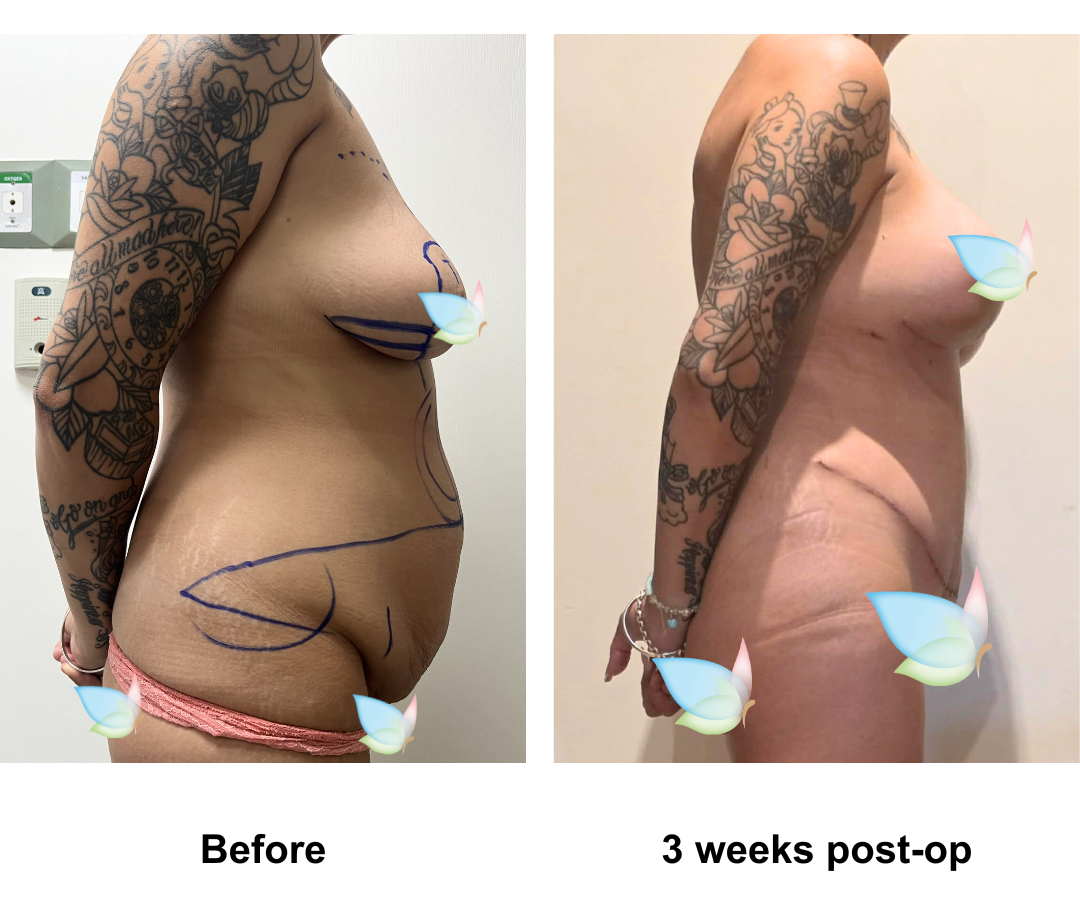 Casee had BABL + ExTT + VASER lipo 2 with Dr. Kasemsak (1)