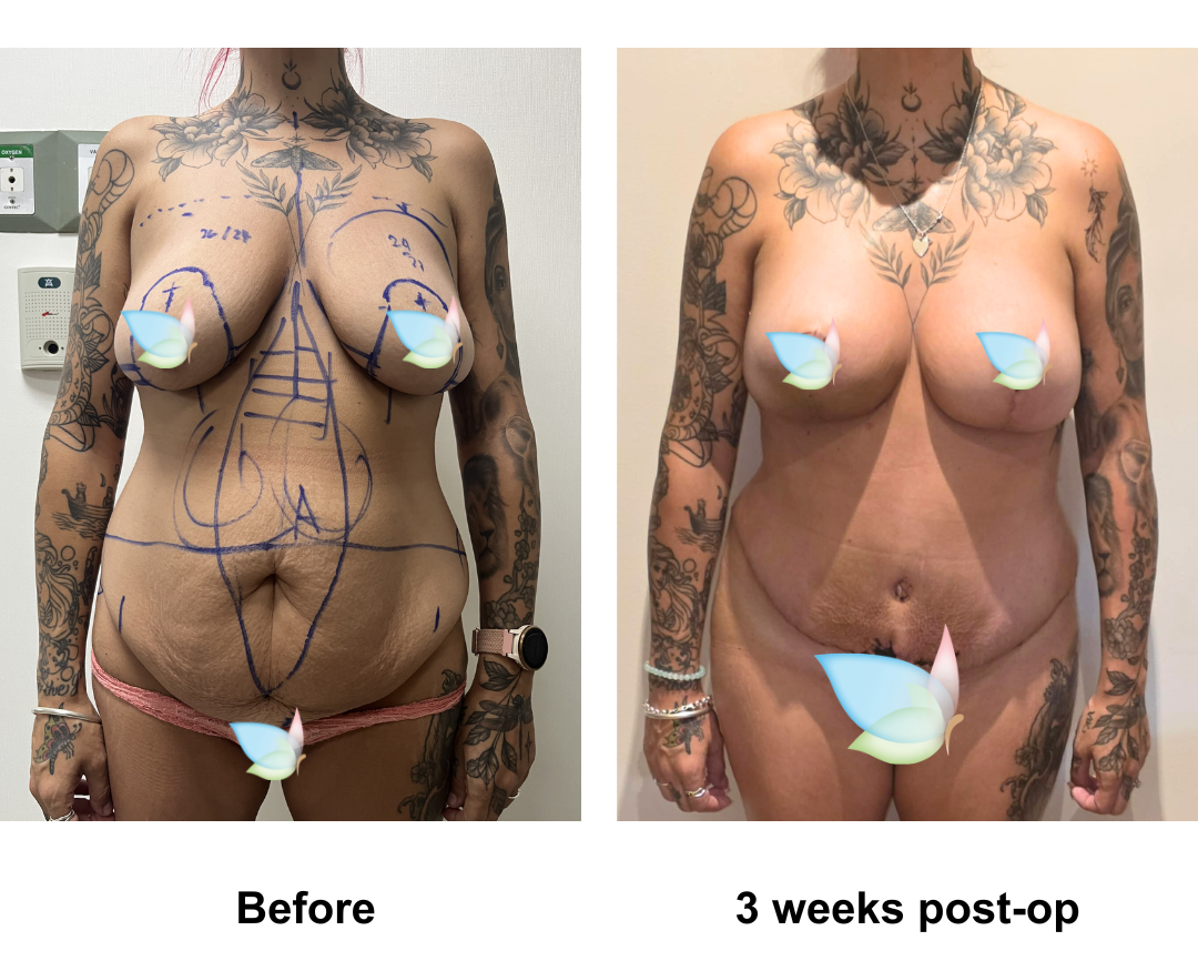 Casee had BABL + ExTT + VASER lipo 2 with Dr. Kasemsak