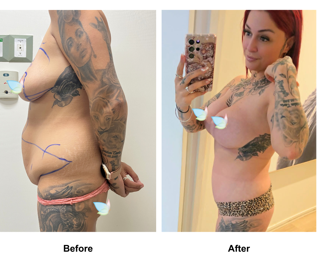 Casee had BABL + ExTT + VASER lipo2 with Dr. Kasemsak - 3 months