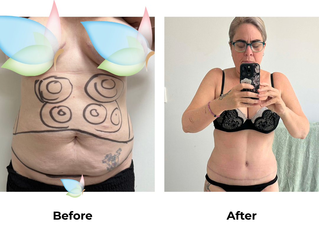 Cassandra had ExTT + Lipo2 (upper abs, love handles) with Dr. Ring (1)