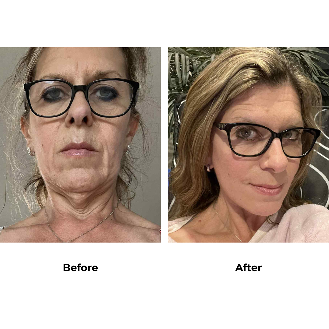 Catherine had  MFNL + Chin lift with Dr. Ring (2)