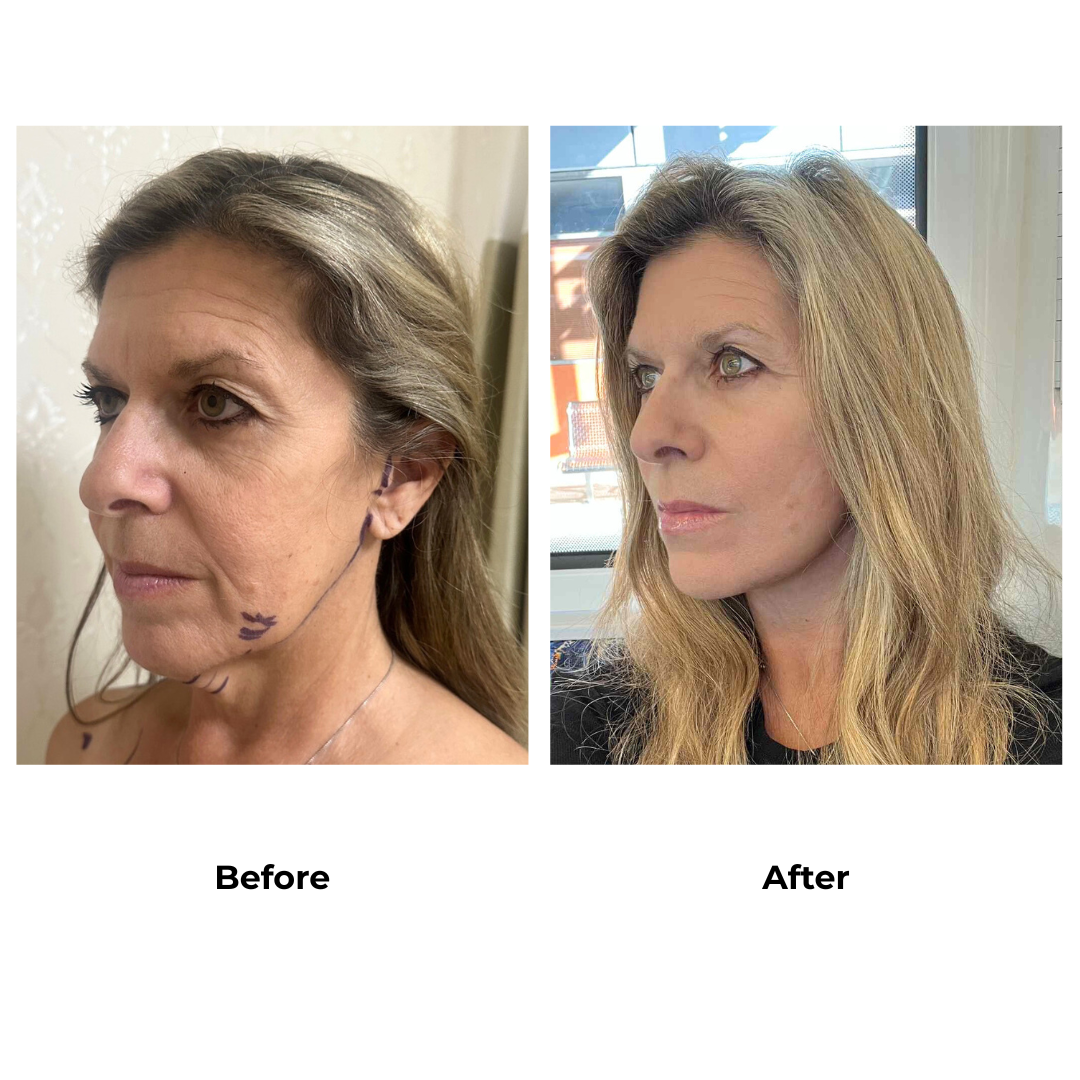 Catherine had  MFNL + Chin lift with Dr. Ring (3)