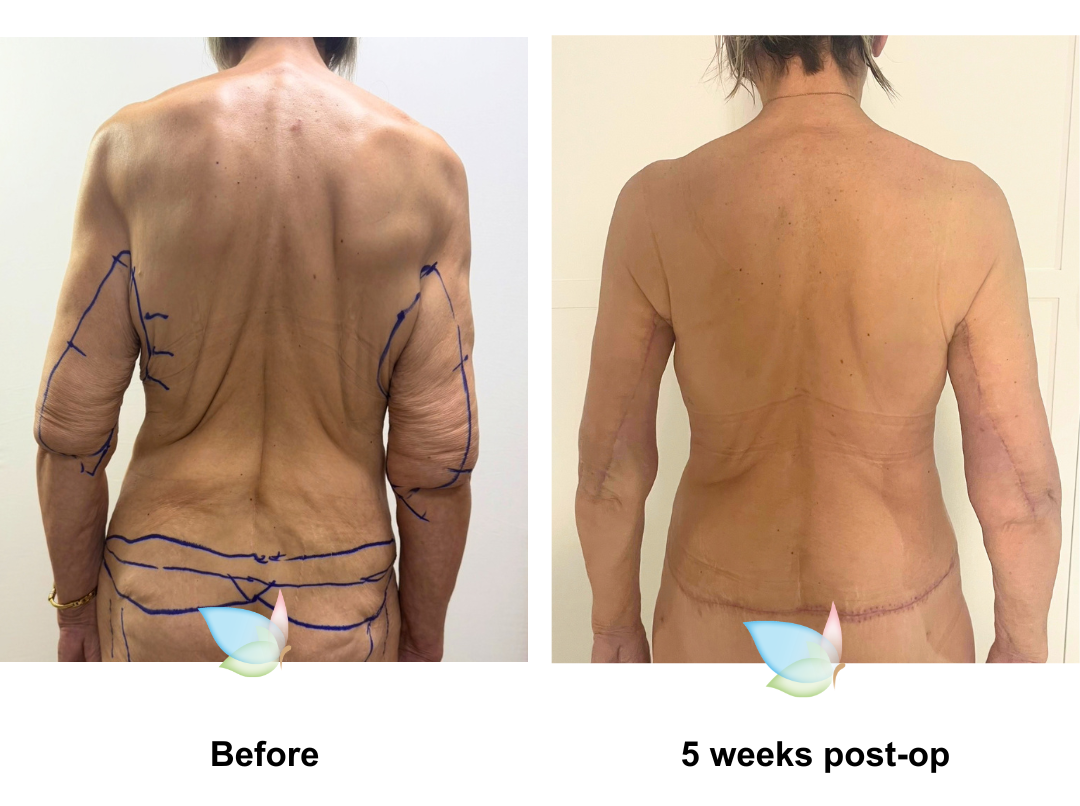 Catherleen had Circum TT + Mon lift + BABL (285, 300 Motiva Demi) + SL + AL with Dr. Ring (2)-1