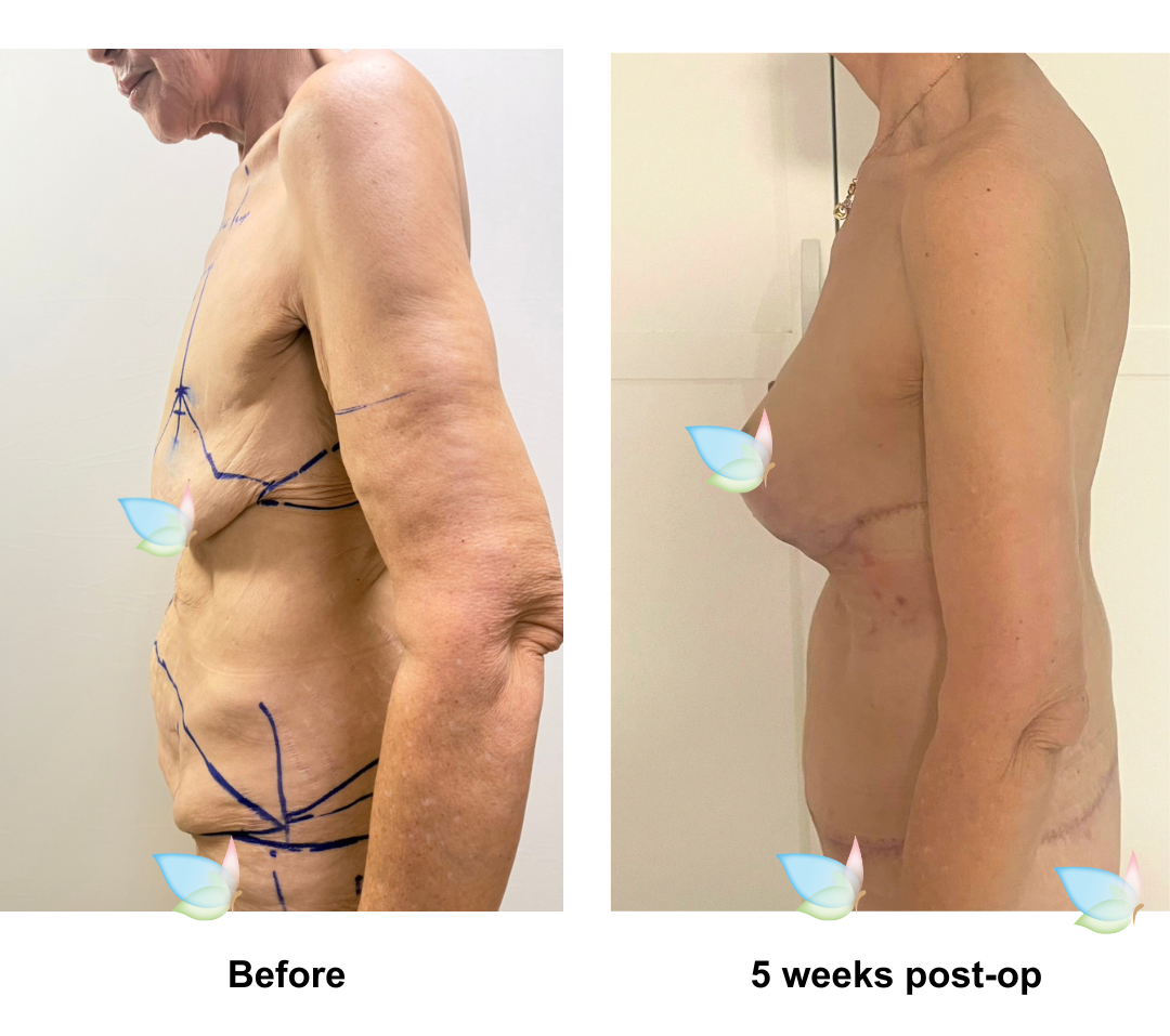 Catherleen had Circum TT + Mon lift + BABL (285, 300 Motiva Demi) + SL + AL with Dr. Ring (3)