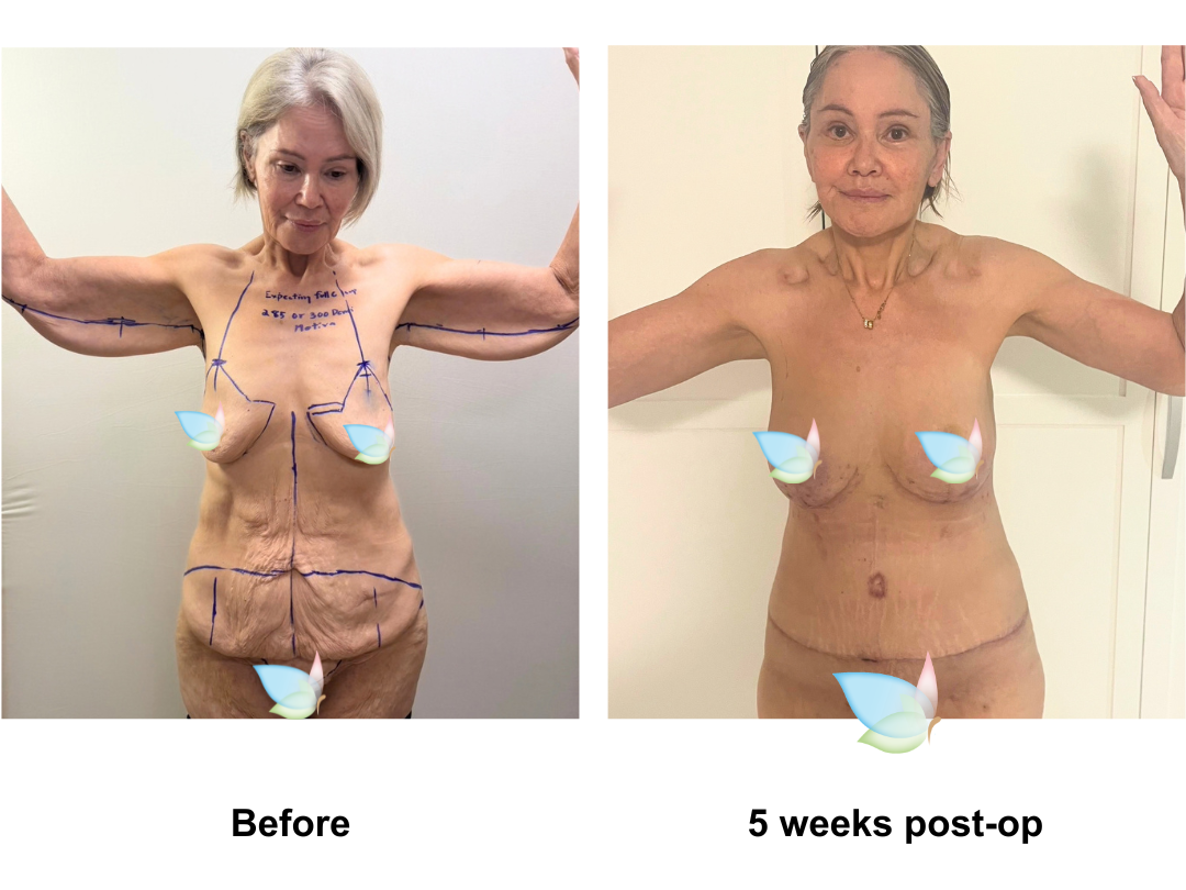 Catherleen had Circum TT + Mon lift + BABL (285, 300 Motiva Demi) + SL + AL with Dr. Ring-1