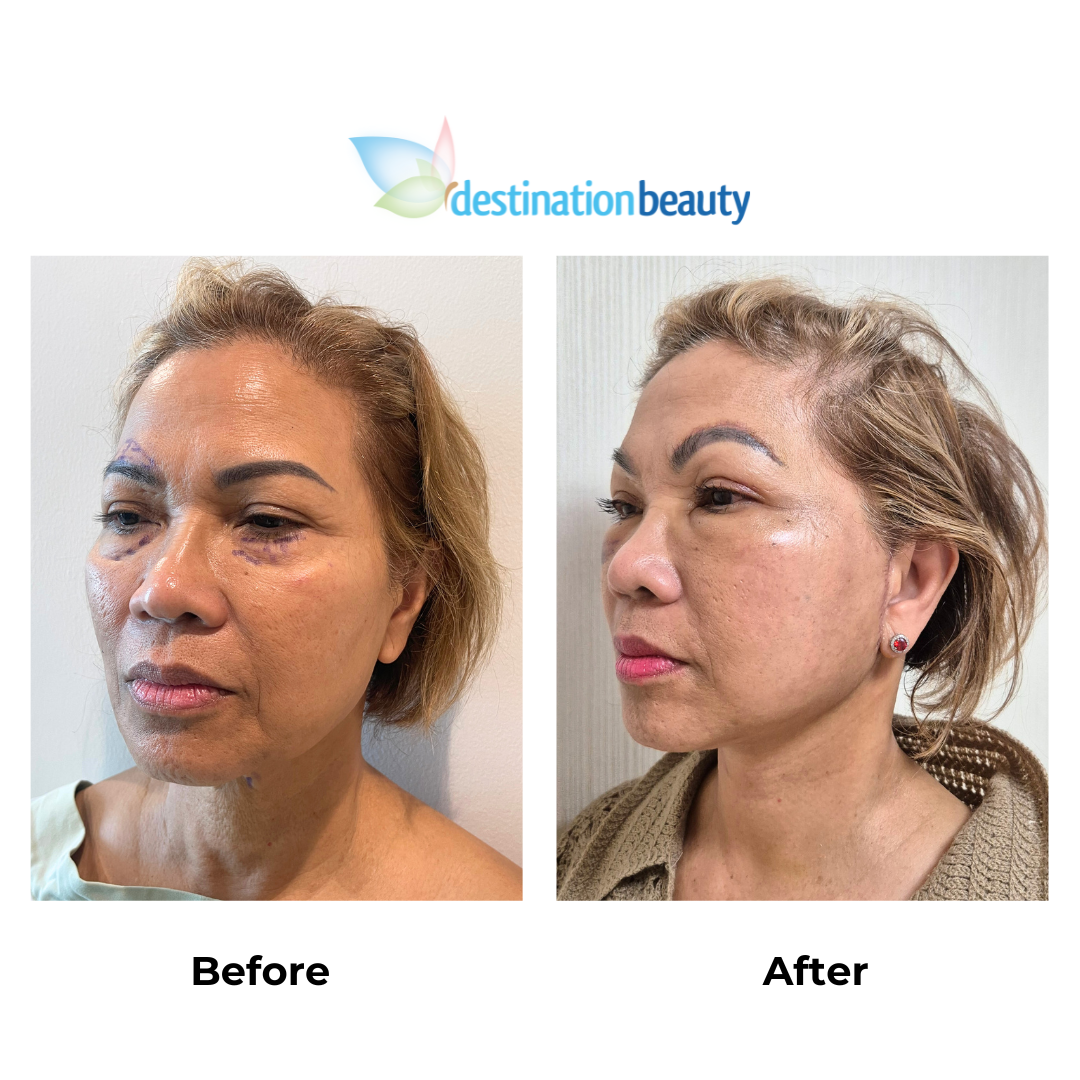 Cecille had facelift in Thailand with Dr. NJ (2)