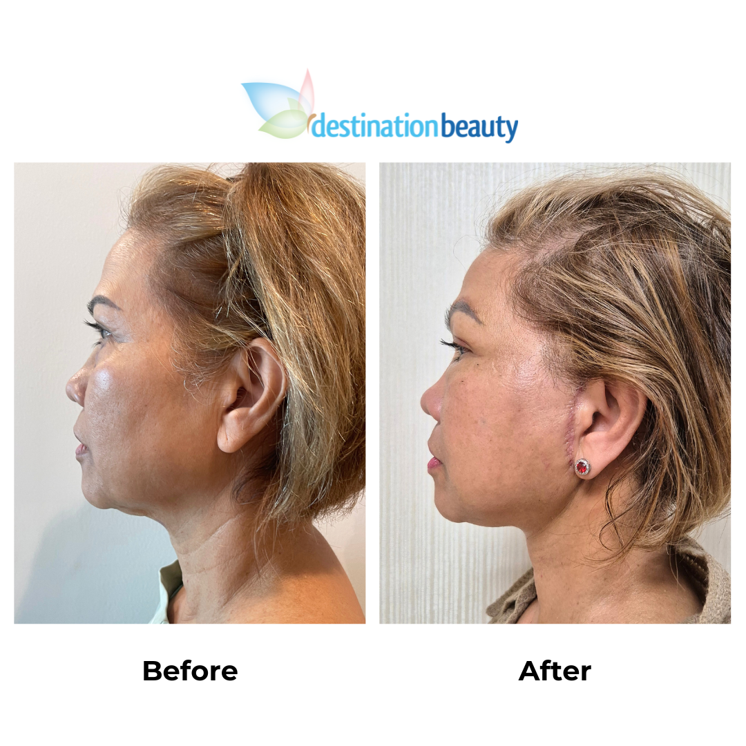 Cecille had facelift in Thailand with Dr. NJ